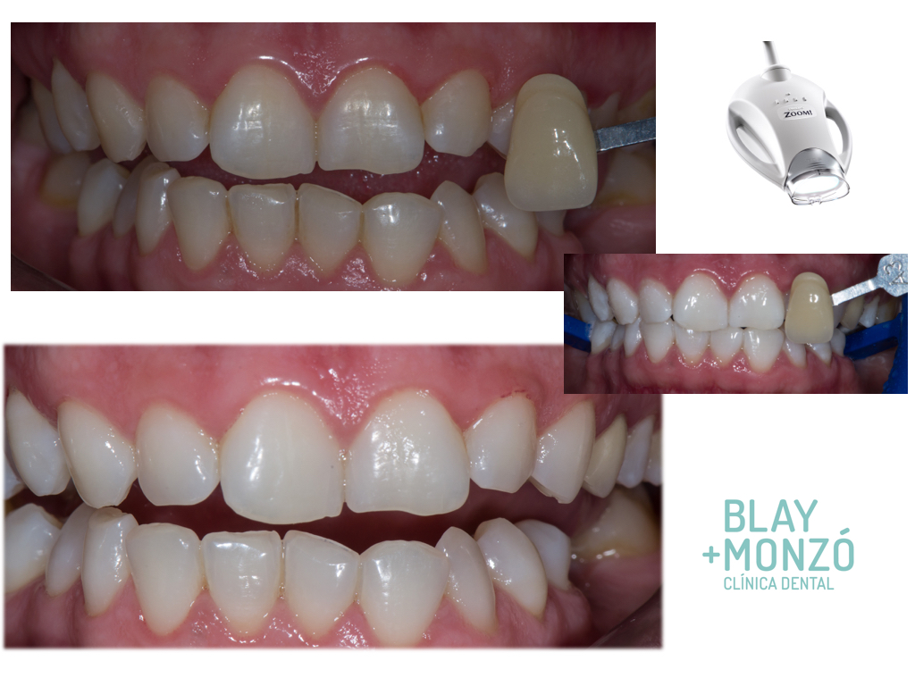 Caso blanqueamiento dental sistema zoom