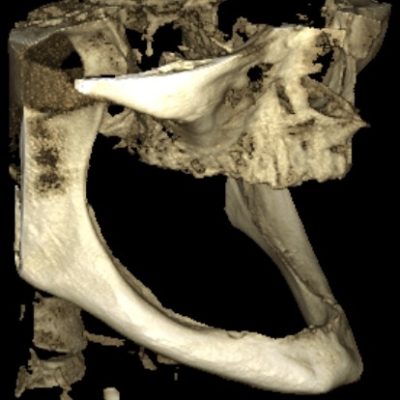 TAC Biomodelo Tac 3D