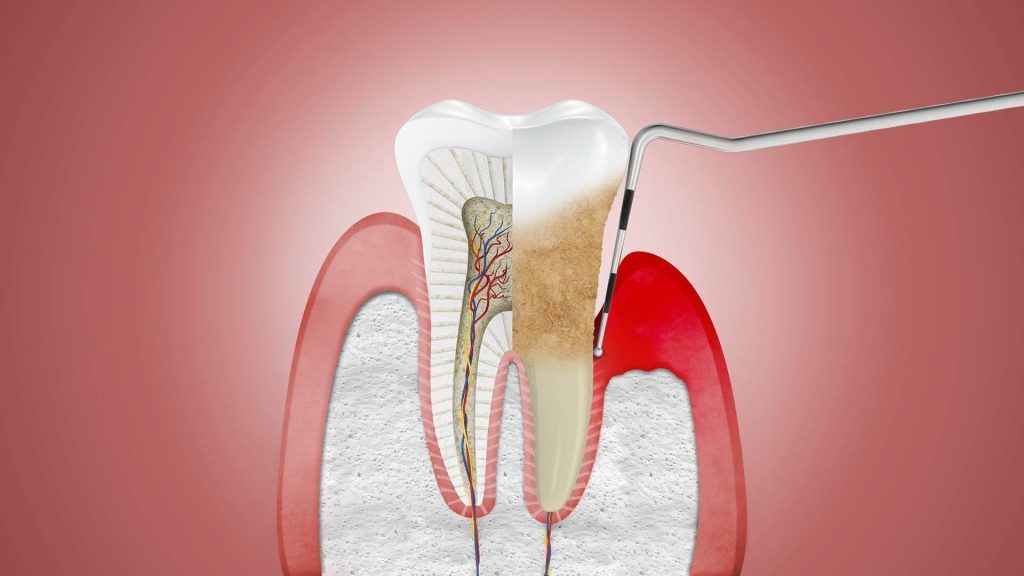 periodoncia en castellon